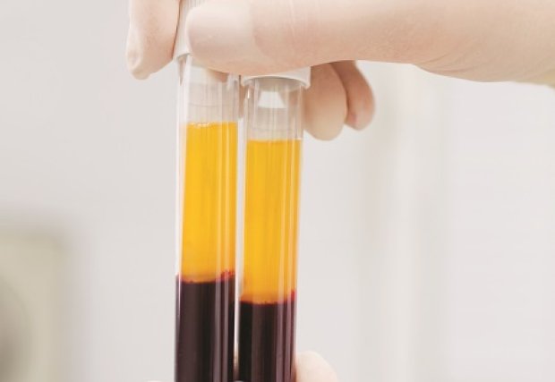 Ask the Doctor: Understanding Platelet-rich Plasma Therapy
